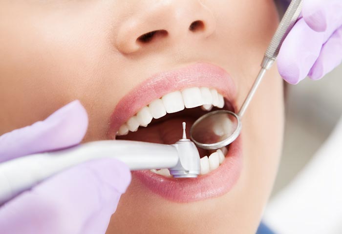 MS-Dental-Fillings-01