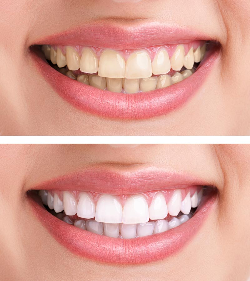 MS-Whitening-01