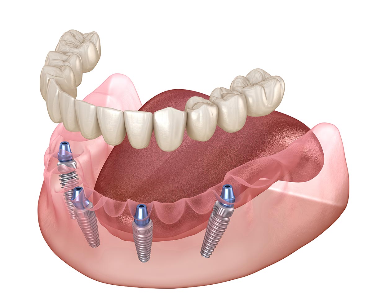 MS-Implants-01